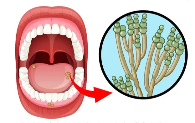 oral candidiasis disease