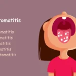 stomatitis