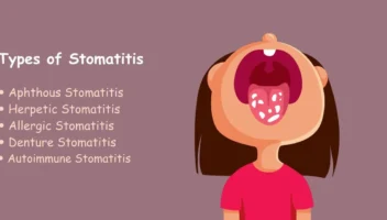 stomatitis