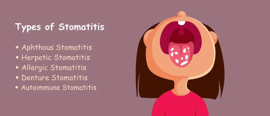 stomatitis