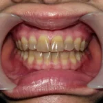 tetracycline discoloration