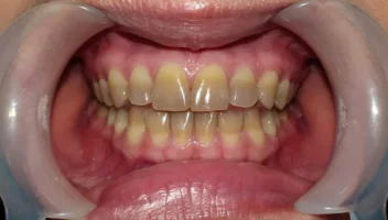 tetracycline discoloration