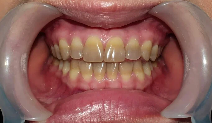 tetracycline discoloration