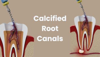 calcified root canals