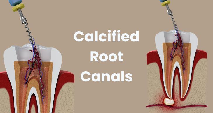 calcified root canals