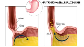 gerd on oral health