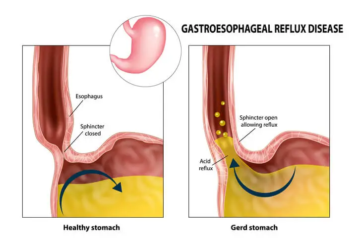 gerd on oral health