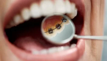 lingual braces