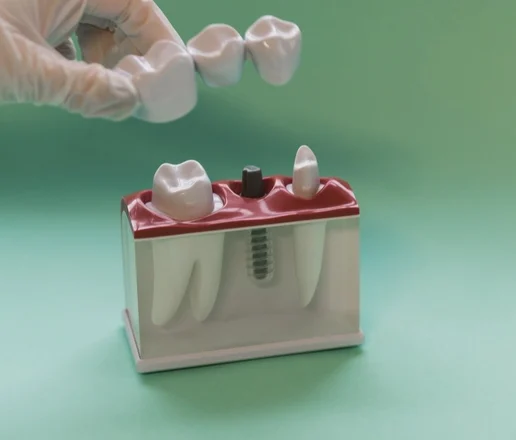 mini dental implants