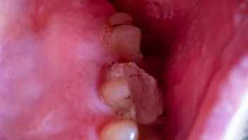 oral mucositis