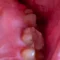 oral mucositis