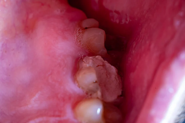 oral mucositis