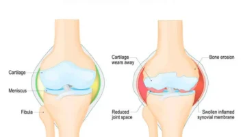 rheumatoid arthritis