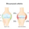 rheumatoid arthritis