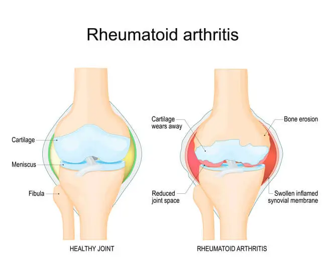 rheumatoid arthritis