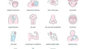 sjogren's syndrome