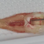 tooth root perforation