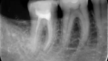 Mineral Trioxide Aggregate Root Obturation