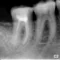 Mineral Trioxide Aggregate Root Obturation