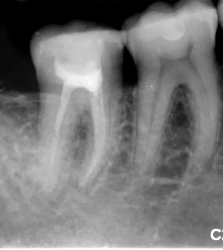 Mineral Trioxide Aggregate Root Obturation