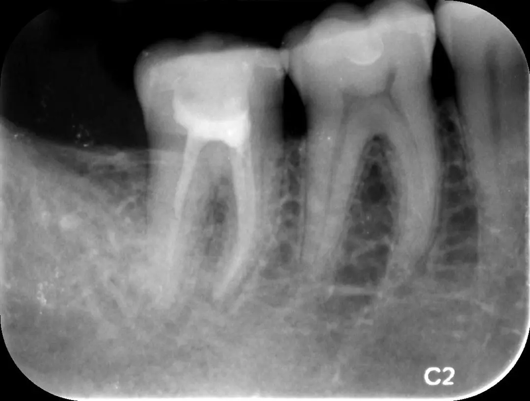 Mineral Trioxide Aggregate Root Obturation