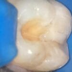 cracked tooth syndrome