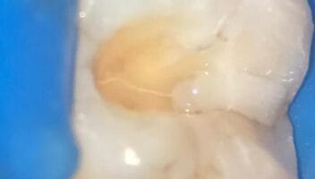 cracked tooth syndrome