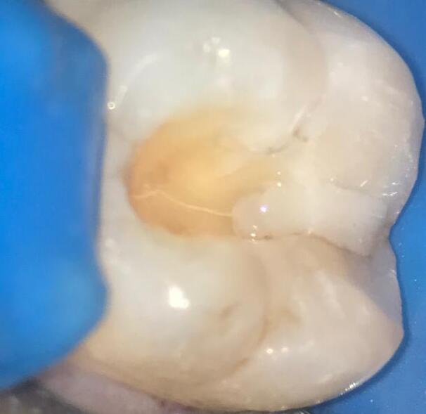 cracked tooth syndrome