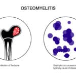 osteomyelitis