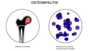 osteomyelitis