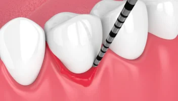 periodontal probing