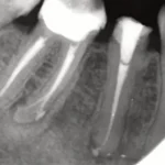 root canal obturation