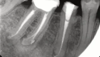 root canal obturation