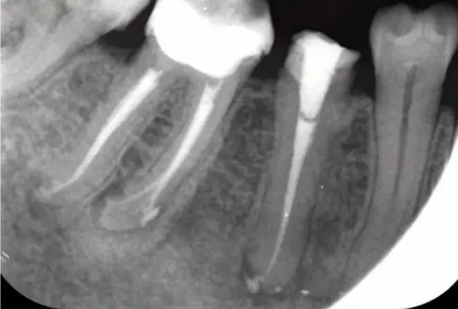 root canal obturation