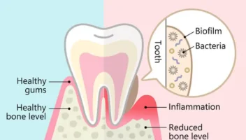 gum sensitivity