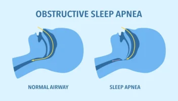 sleep apnea