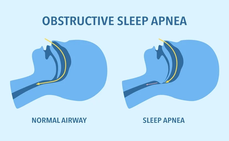 sleep apnea