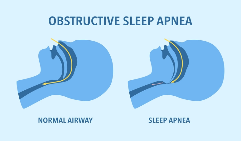 sleep apnea