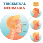 trigeminal neuralgia