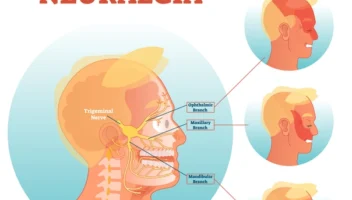 trigeminal neuralgia