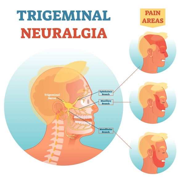 trigeminal neuralgia