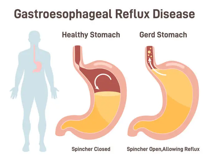 acid reflux