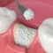 bone grafting