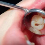 detecting tooth decay