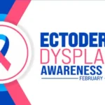 ectodermal dysplasia