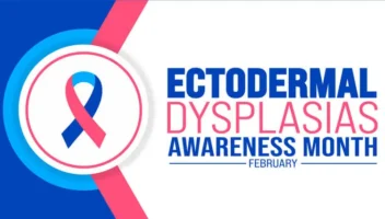 ectodermal dysplasia