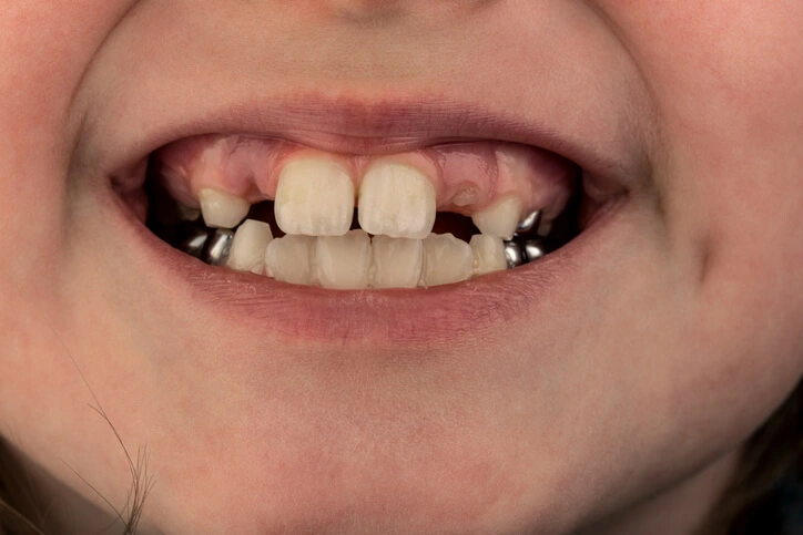 hypodontia