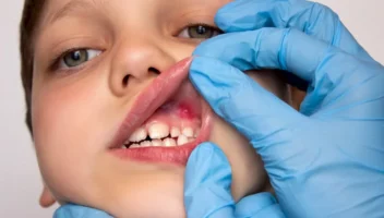 oral soft tissue injuries