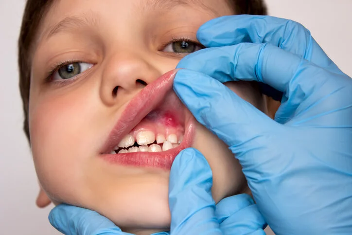 oral soft tissue injuries