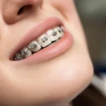 orthodontic treatments